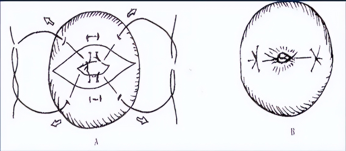 宫颈锥切手术的操作能力和技巧