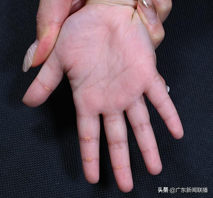 国际首次命名这种“罕见遗传病”！源自广东这支医生团队