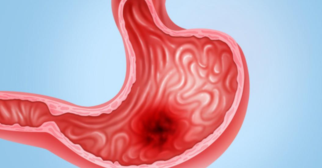 胃溃疡主要护理问题及措施,胃溃疡如何保养护理