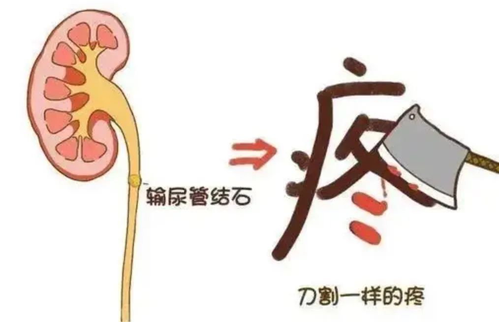 急性肾绞痛是几级,急性肾绞痛吃什么药止痛