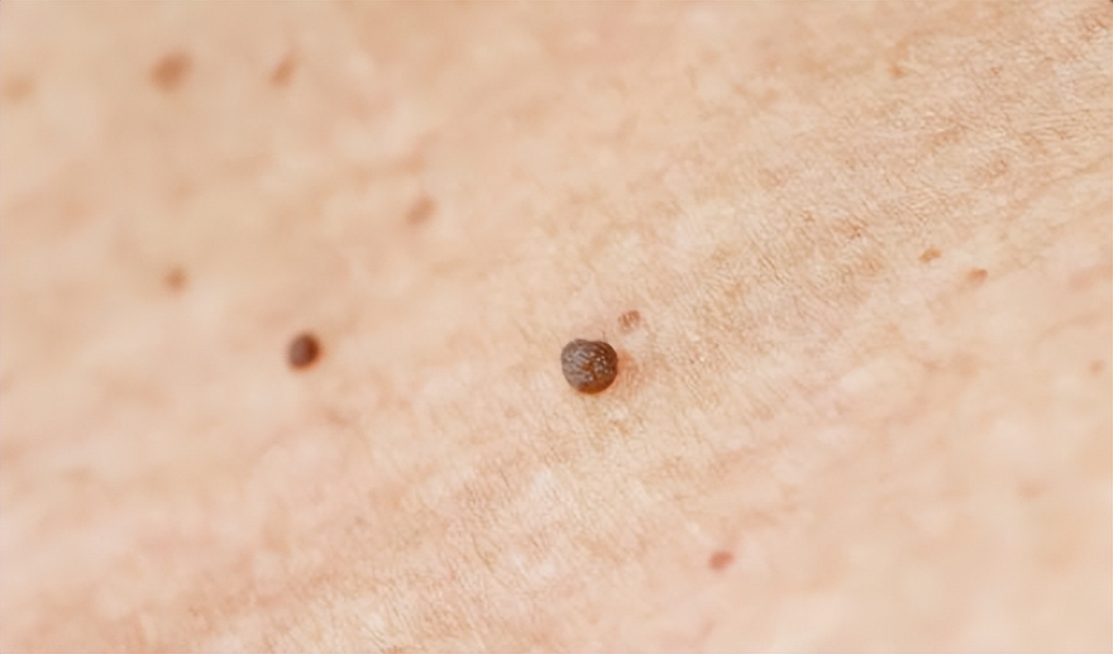 脖子上肉粒可以自己揪掉么,脖子腋下长小肉粒可以用手揪掉吗