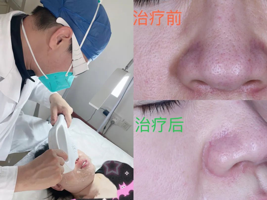 解决毛孔粗大的方法收藏起来,解决毛孔粗大的秘籍你值得拥有