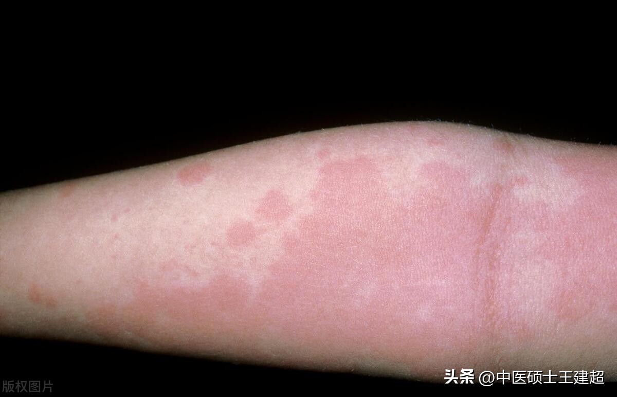 小孩出麻疹水痘全身瘙痒怎么办,荨麻疹皮肤表皮温度高是什么原因
