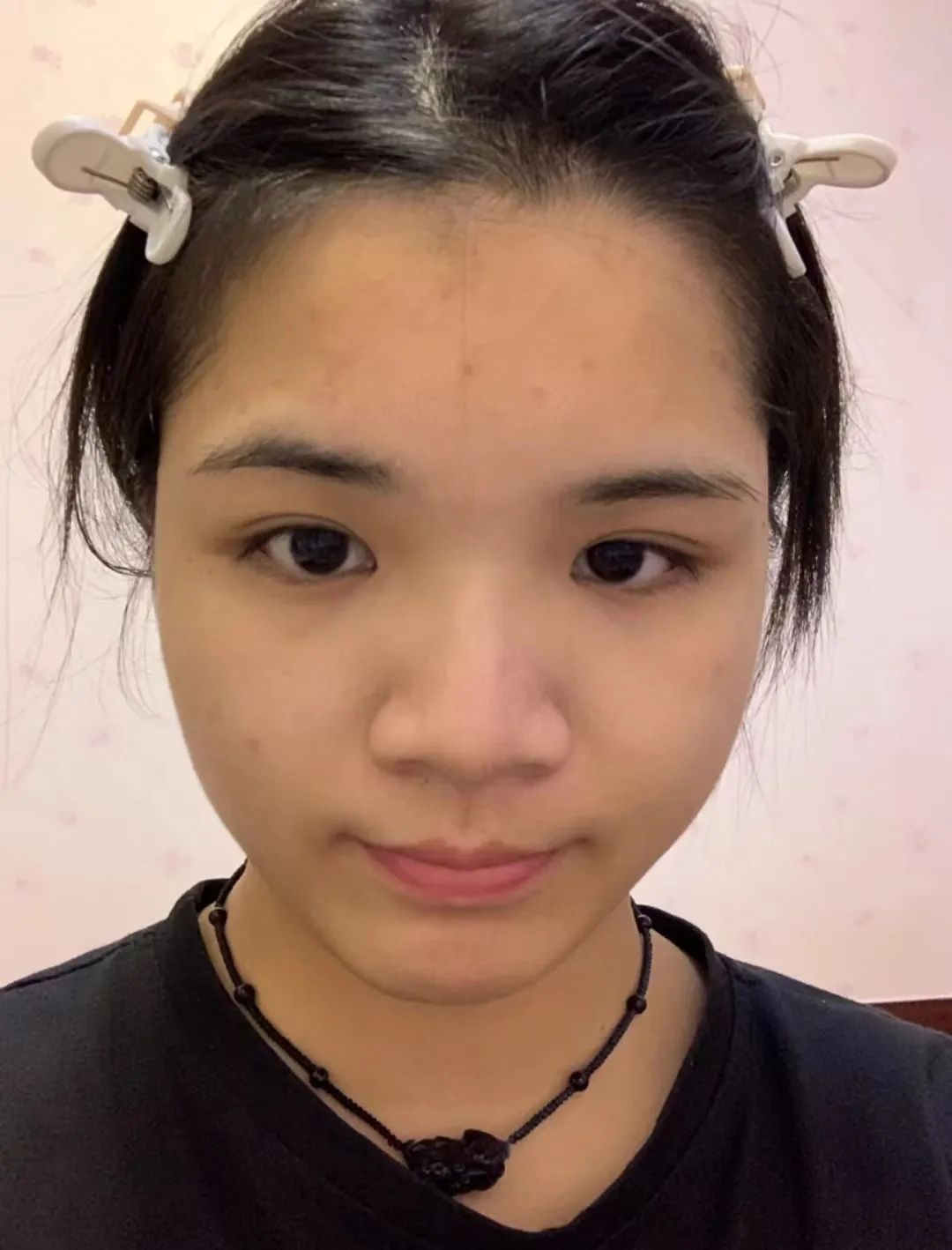 塌鼻子正脸好看,塌鼻子该如何变美啊