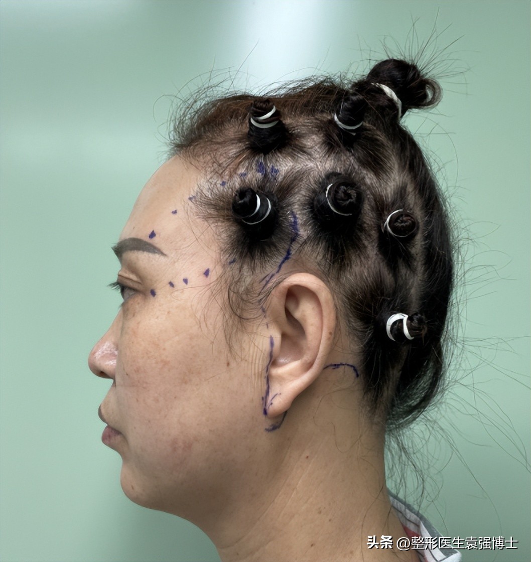 40岁做拉皮多久恢复,47岁拉皮恢复的真实分享