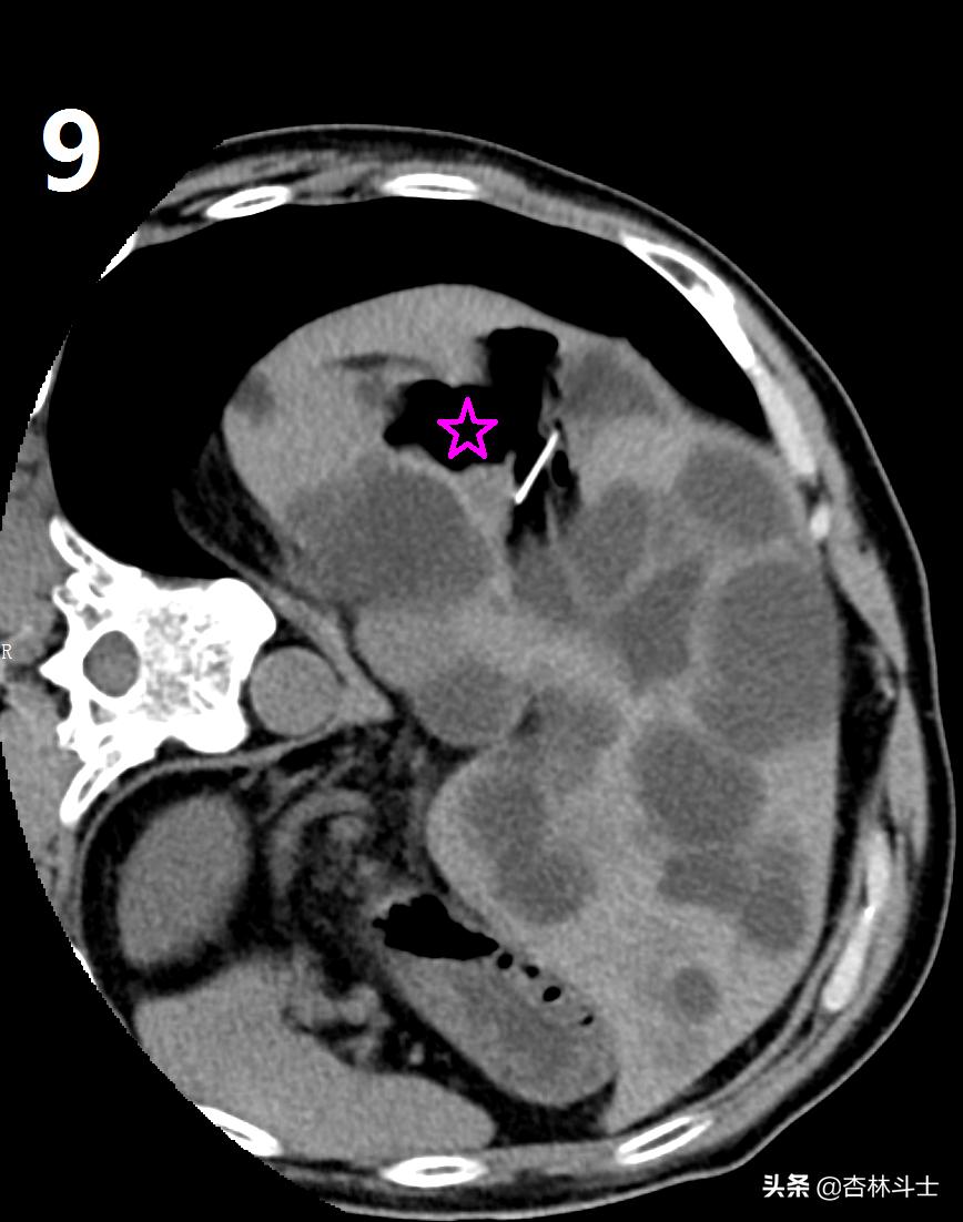 64岁银行职员患肝囊肿，CT引导下细针穿刺抽吸酒精硬化解决大问题