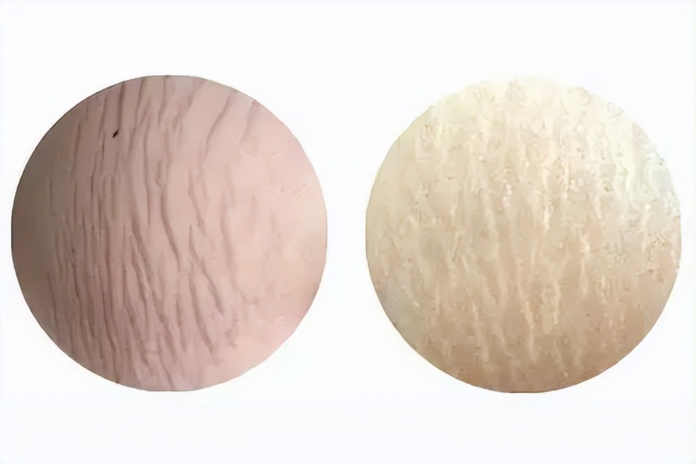 隐性肥胖的最佳治疗方法,隐形肥胖怎么消除