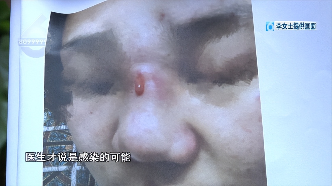 鼻子整形后流脓是不是医疗事故,鼻子整容后流脓怎么处理