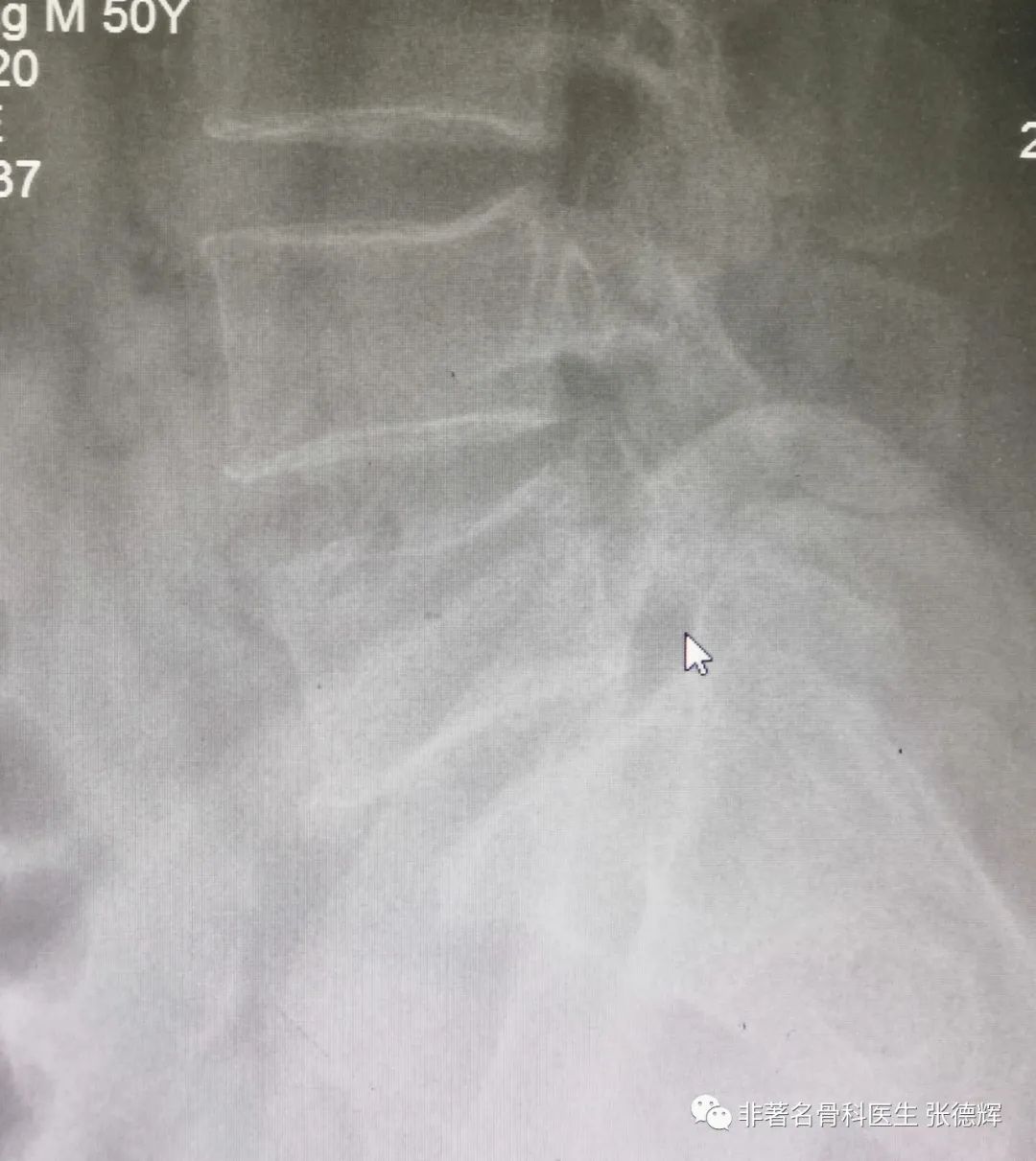 腰椎峡部裂的最好治疗方法,腰椎峡部裂