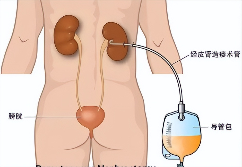 排尿困难？有可能是输尿管梗阻！