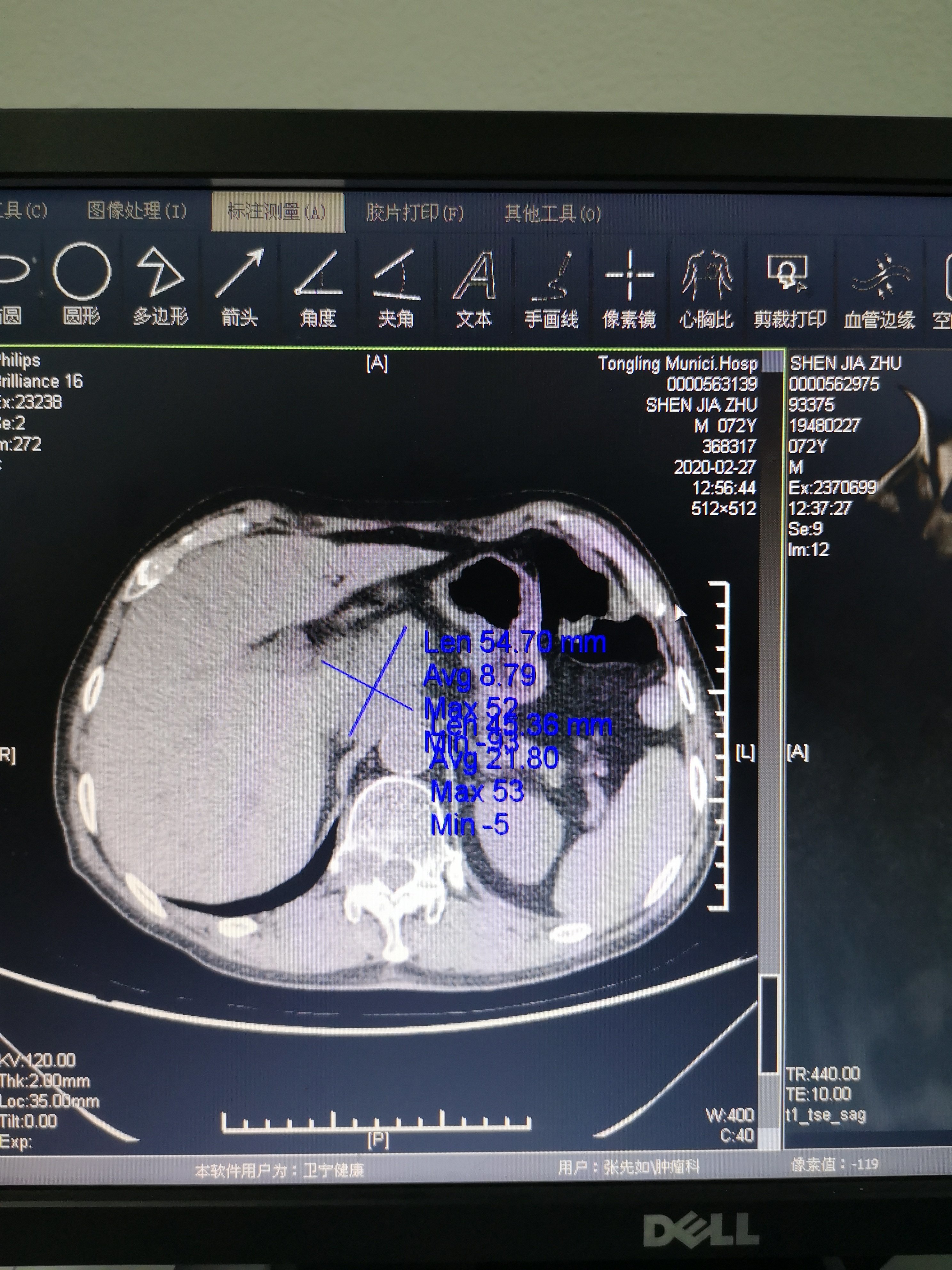 食管癌诊断金标准,食管癌诊疗规范2020电子版