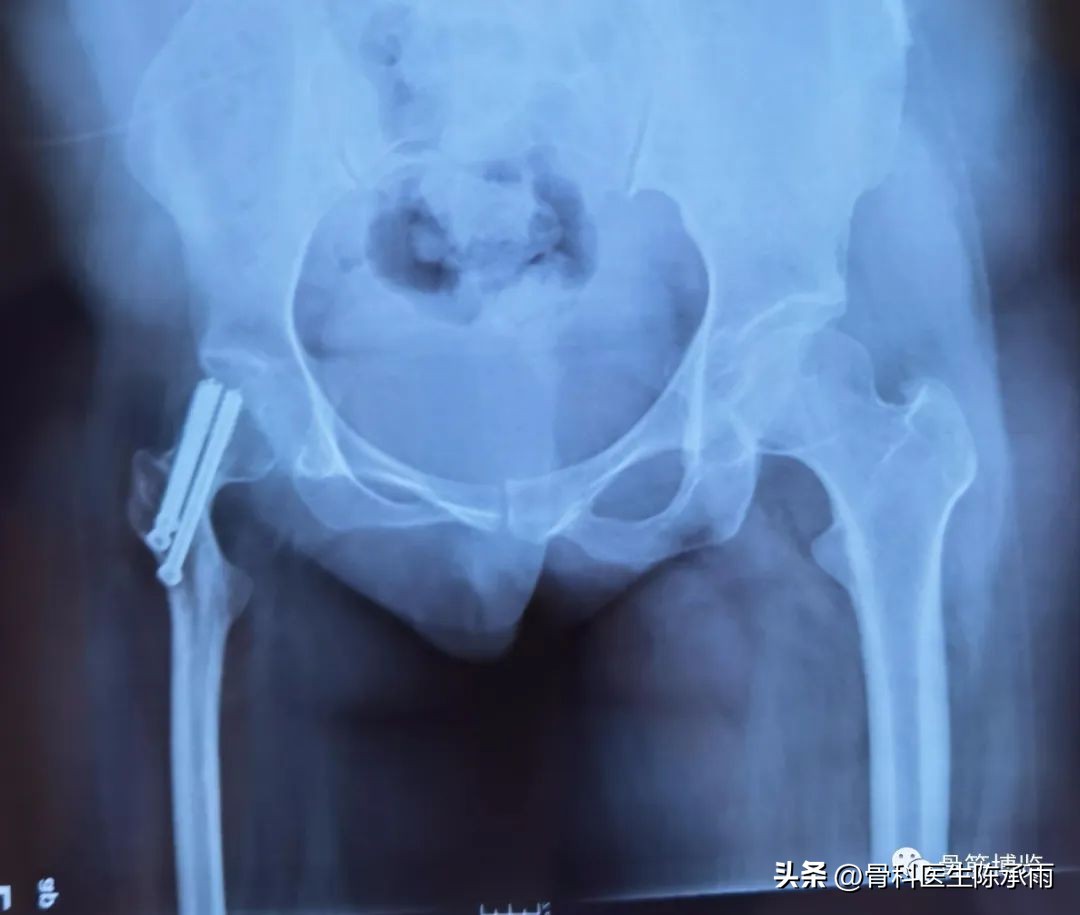 股骨颈闭合复位内固定术后护理,股骨颈骨折闭合复位的技巧