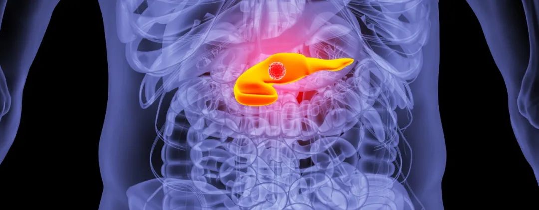 胰腺癌有突破10年的吗,一旦确诊胰腺癌还能活多久