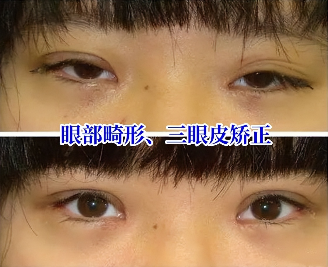 双眼皮变成三眼皮有什么寓意,双眼皮为什么会变成三层