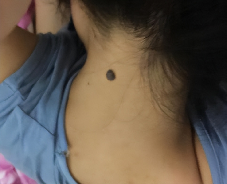 医生发现大黑痣的秘密,这些地方长黑痣要注意