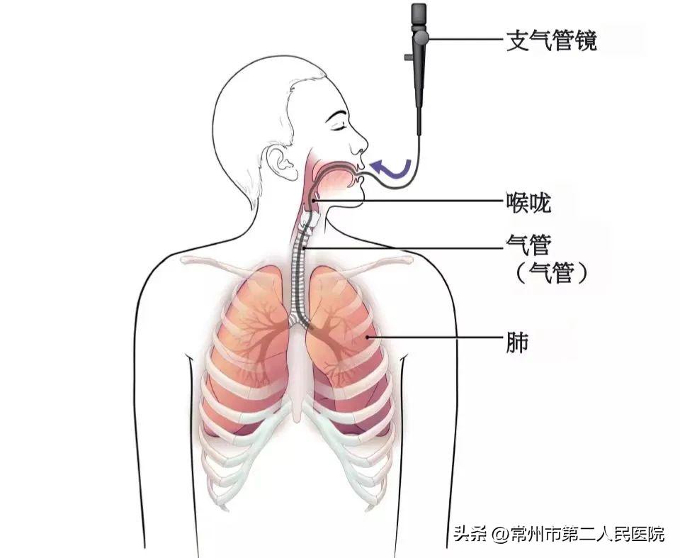 支气管炎引起的气喘可以治愈吗,不明原因的气喘做支气管镜检查