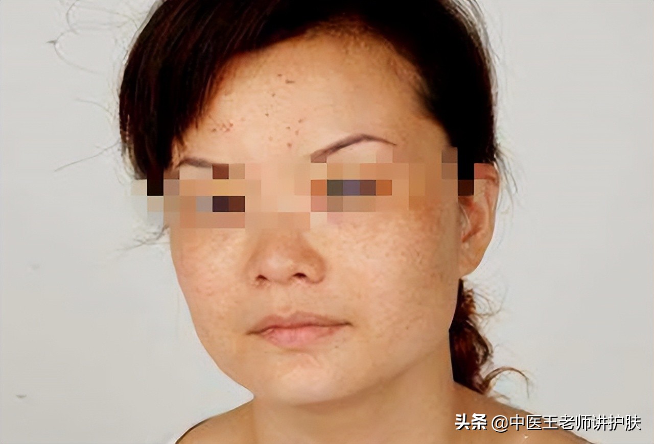 脾虚血瘀长斑怎么食疗,脾虚长痘吃中药多久能见效