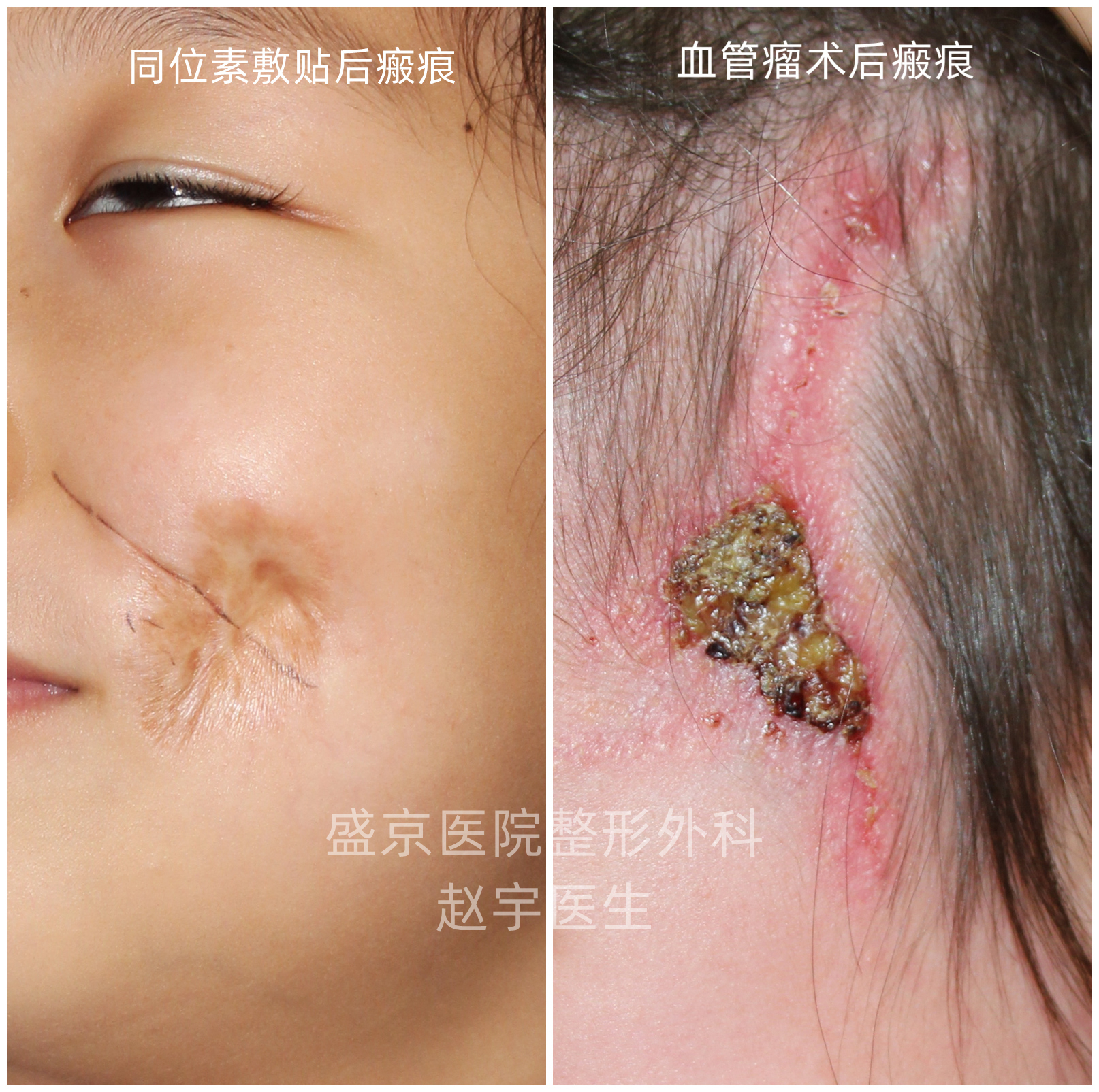 婴儿红胎记,婴儿红胎记图片大全