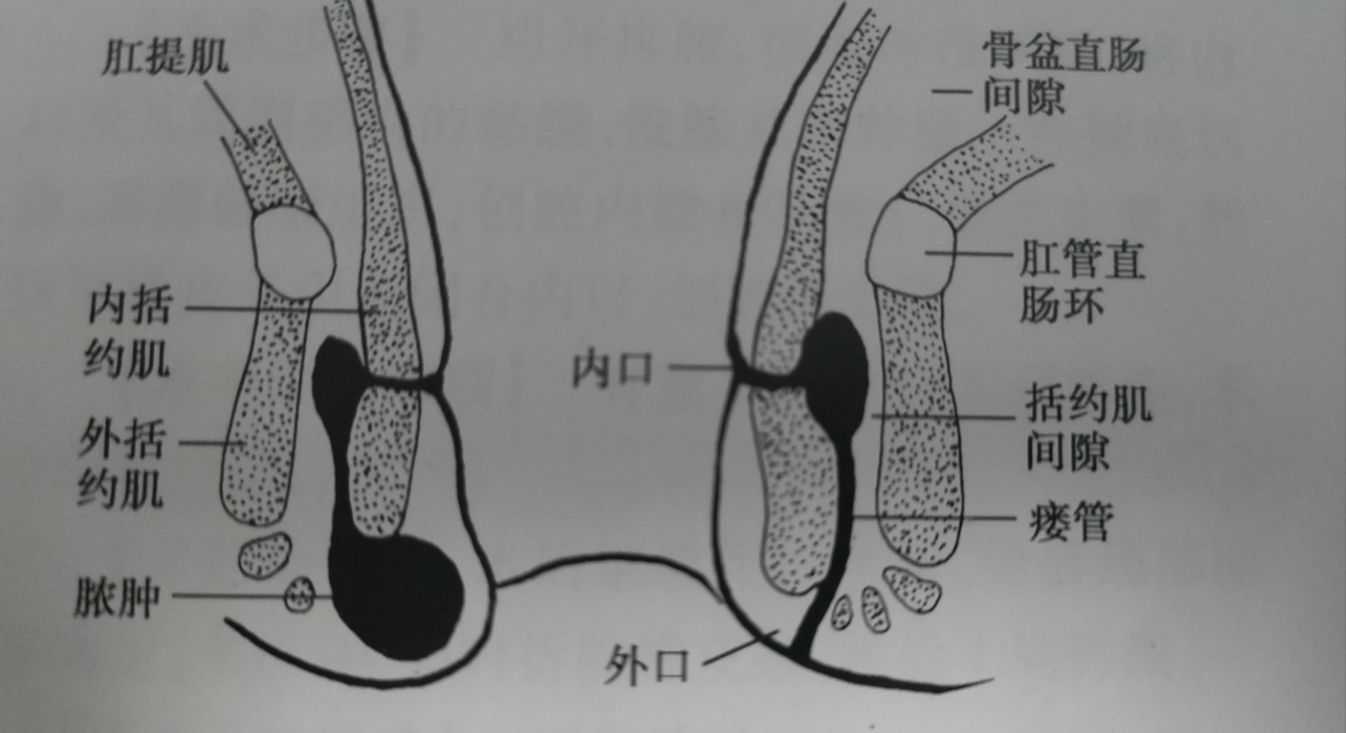 同样是肛瘘,为什么别人术后2天就出院,而我术后七天还出不了院