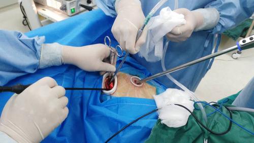 腹腔镜肾切除示意图,腹腔镜肾脏部分切除术