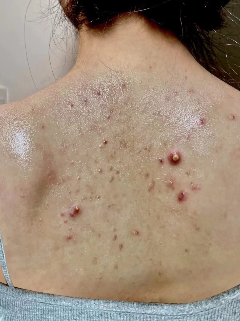 痘痘油光发亮,痘痘清理后很快发脓包