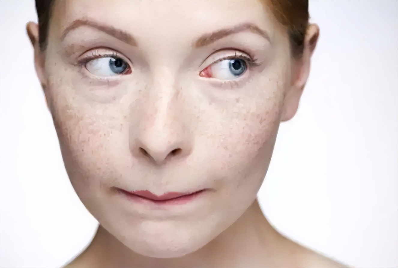 牙膏与红霉素软膏能祛老年斑吗,老年斑消除偏方红霉素软膏加甘油