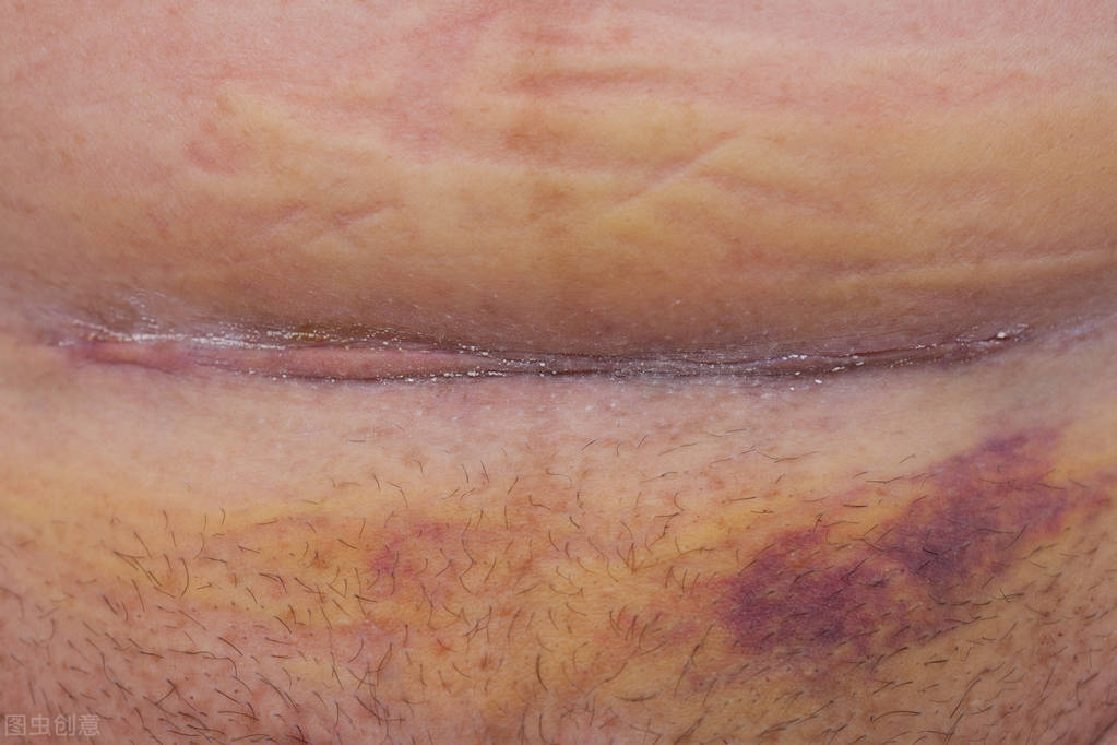 剖宫产疤痕如何看是恢复的比较好,剖宫产疤痕憩室怎么去除