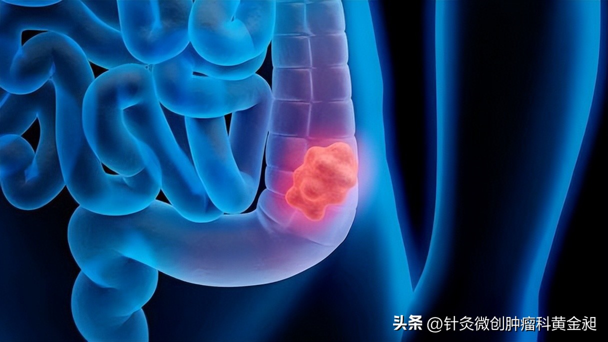 【病案分享】直肠癌康复——中医来助力