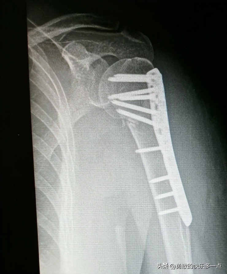 肱骨近端骨折,肱骨近端骨折康复训练