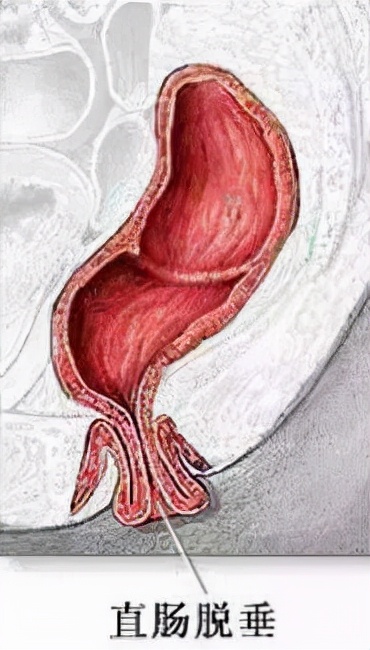 什么是脱肛是怎么回事,什么是脱肛原来这么容易治好