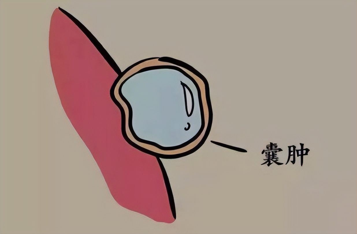 医生说囊肿是良性的但是需要手术,医生处理囊肿的视频