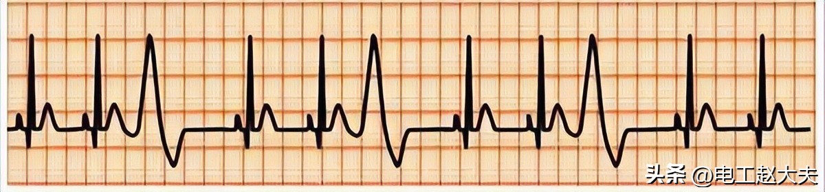 每天都有一两次早搏正常吗,每天几十次早搏