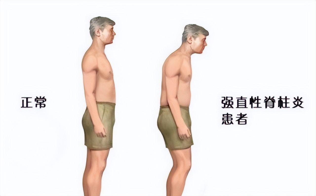 治疗强直性脊柱炎必须按体质治吗,针对强直性脊柱炎最好的锻炼方法