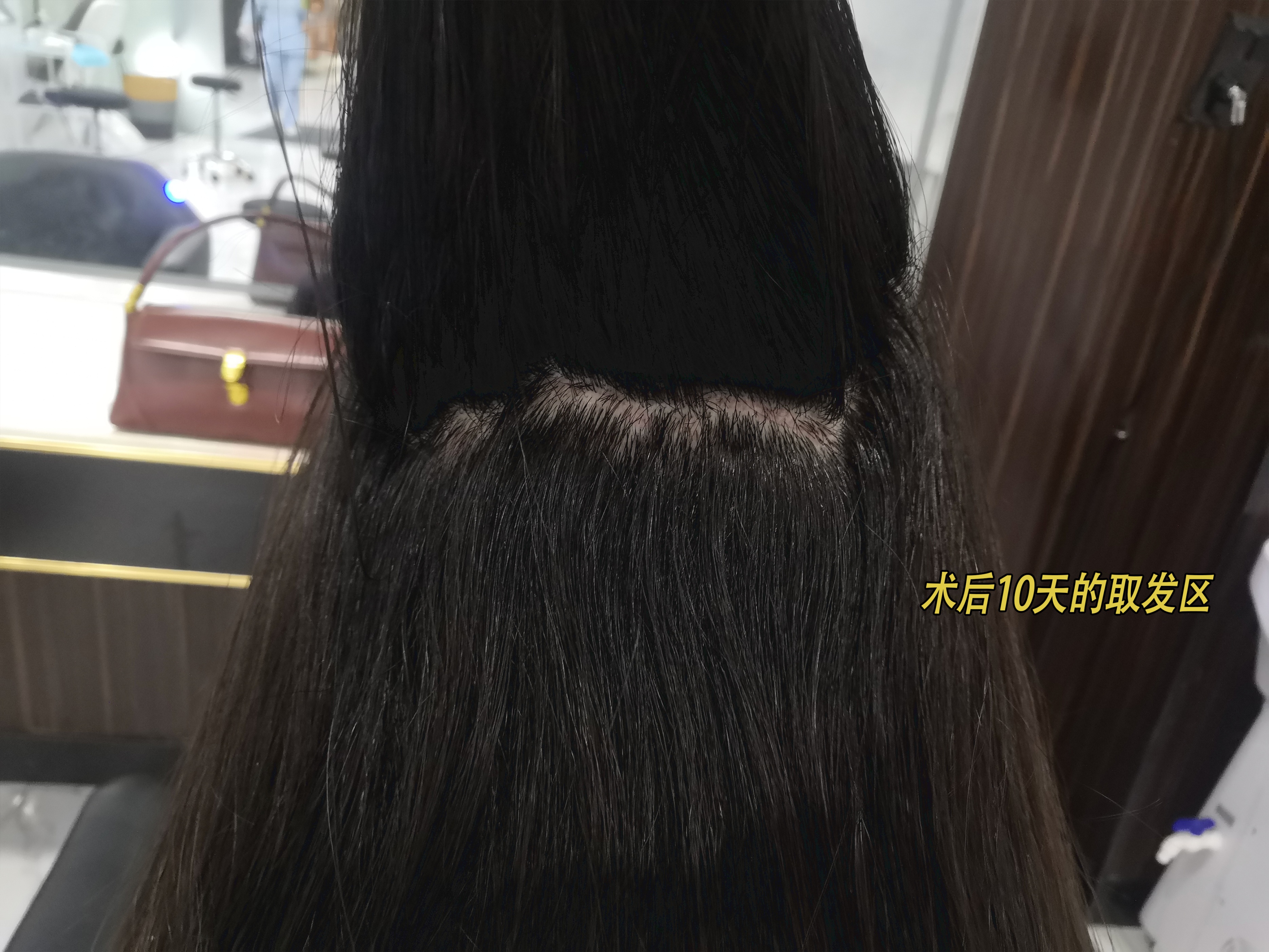 恒美植发后续,恒美植发靠谱不