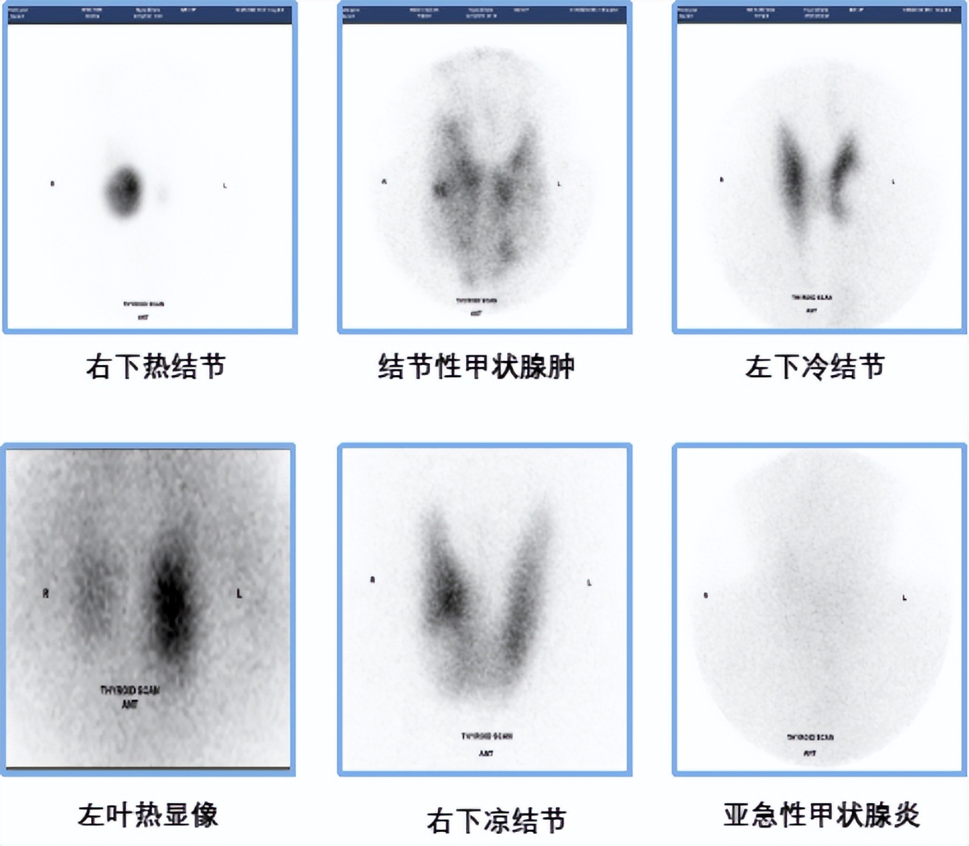 世界甲状腺知识宣传周宣传视频,世界卫生组织甲状腺结节