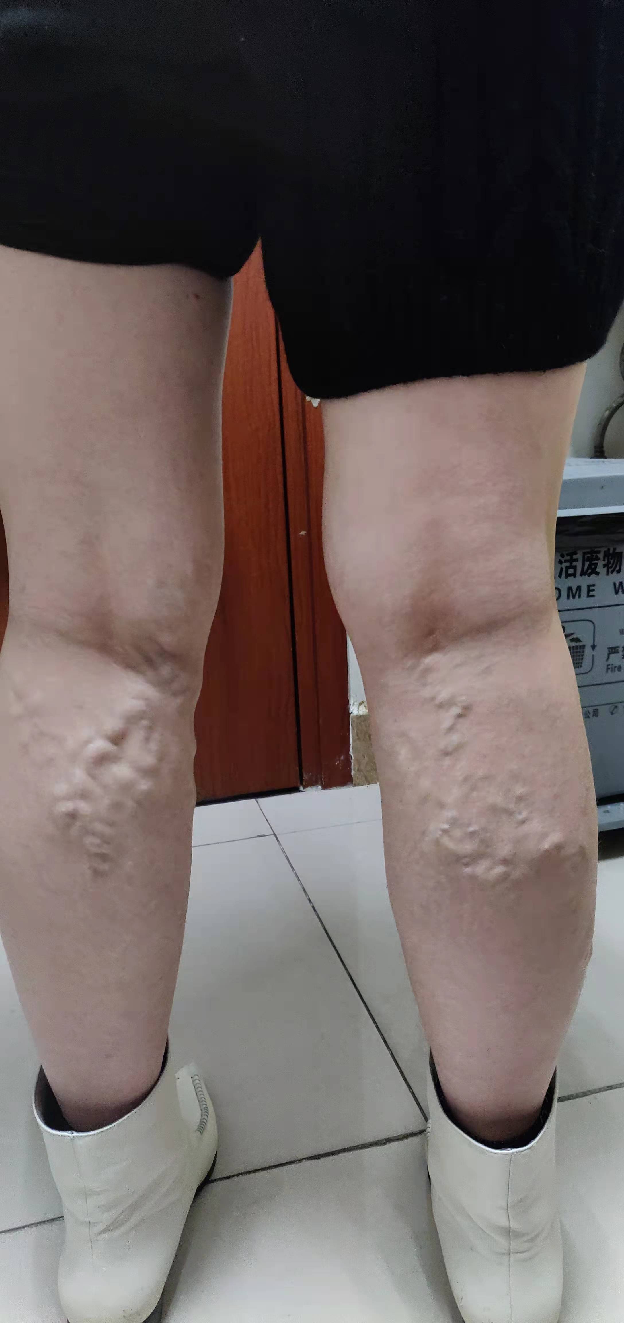 静脉曲张针灸以后为何胀痛,静脉曲张针刺疗法视频