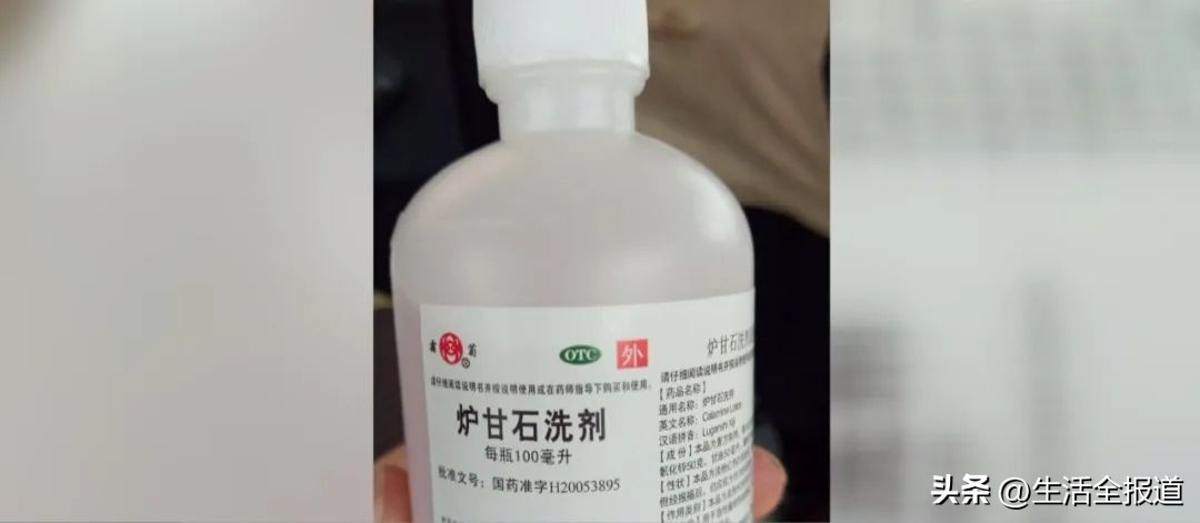 蚊子包止痒妙招,怎么给蚊子包止痒