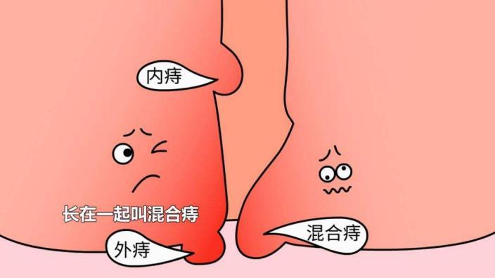 便血?一场悬疑的迷案