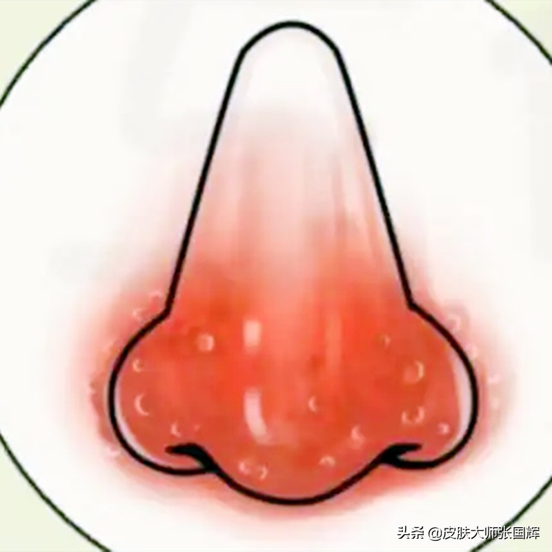 面部玫瑰痤疮平时要注意什么,面部玫瑰痤疮治疗方法