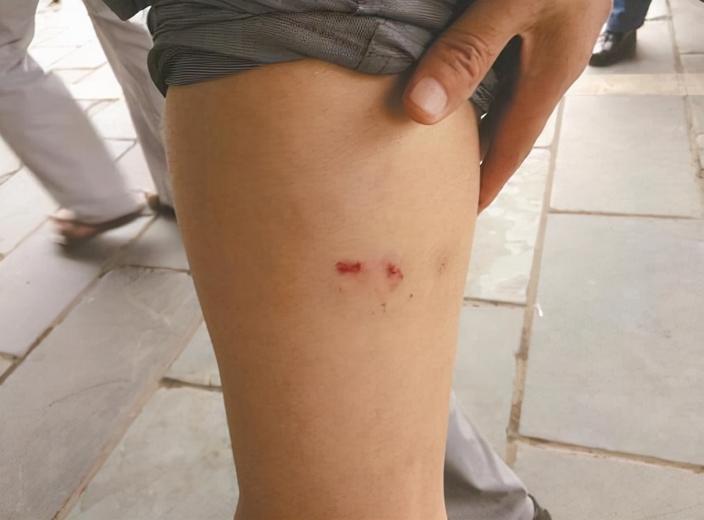 被狗咬了但没出血需要打疫苗吗,被狗咬了没有出血要打狂犬疫苗吗