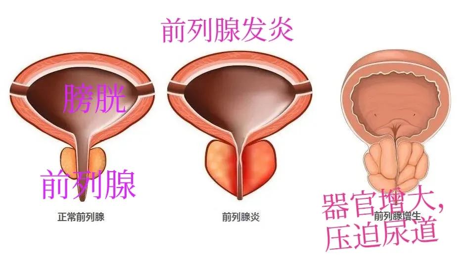 急性前列腺炎怎么治疗最快最好,急性前列腺炎的最佳治疗方法