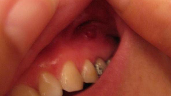 口腔牙龈内壁长硬包是上火吗,牙龈肿痛上火有个脓包怎么办