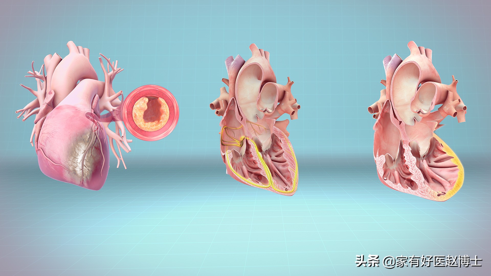 冠心病普利类降压药,冠心病服用沙坦类降压药哪个好