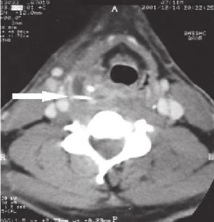协和耳鼻喉科取鱼刺要多少钱,误吞鱼刺在咽喉多久判断没事