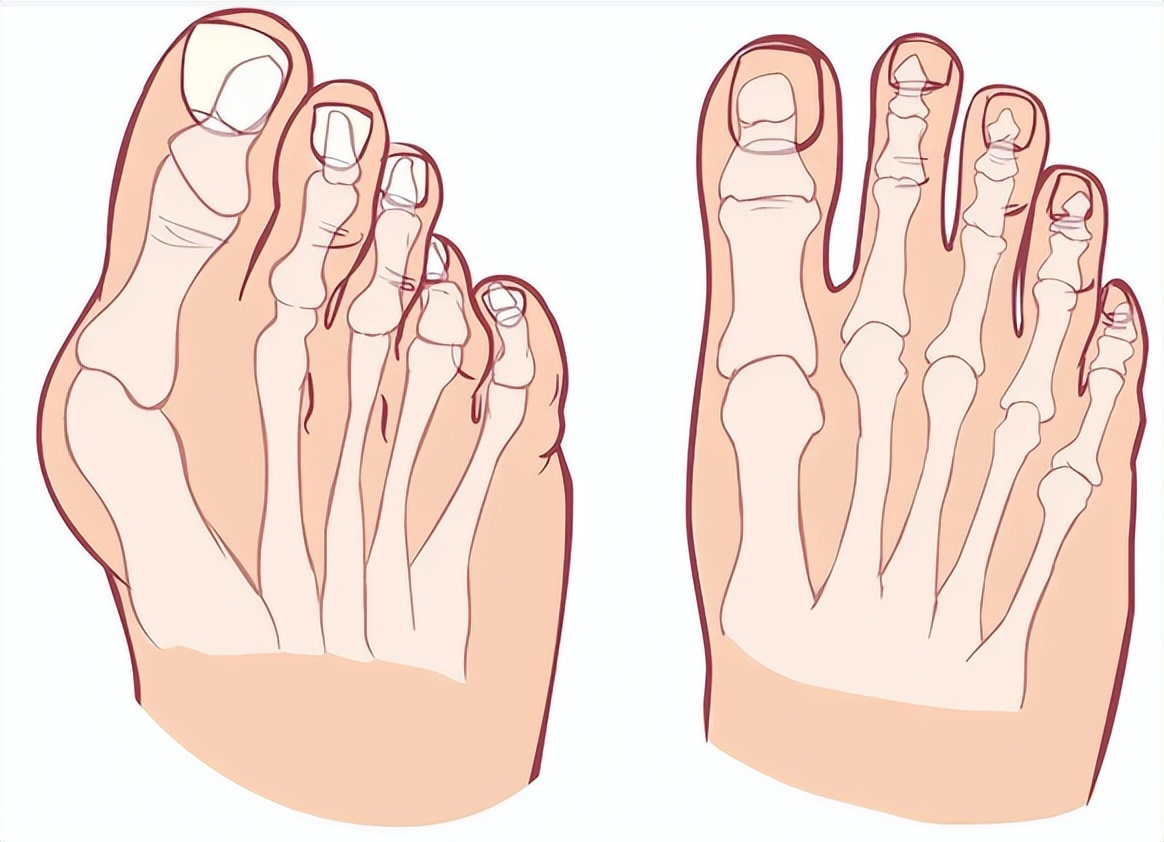 孩子走路姿势不对形象图,孩子走路姿势太丑要不要纠正