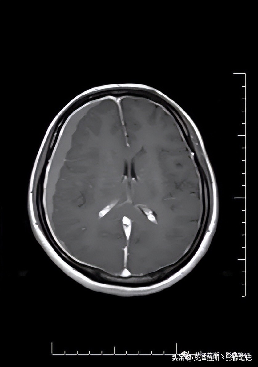 中枢性低通气综合征,中枢性低通气综合征可以治愈吗