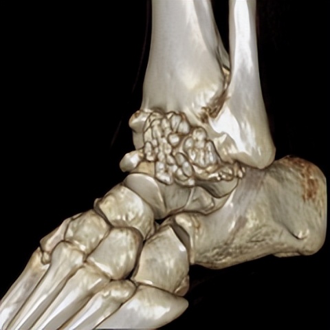 脚踝扭伤的处理方法和注意事项,轻度脚踝扭伤的处理方法及康复