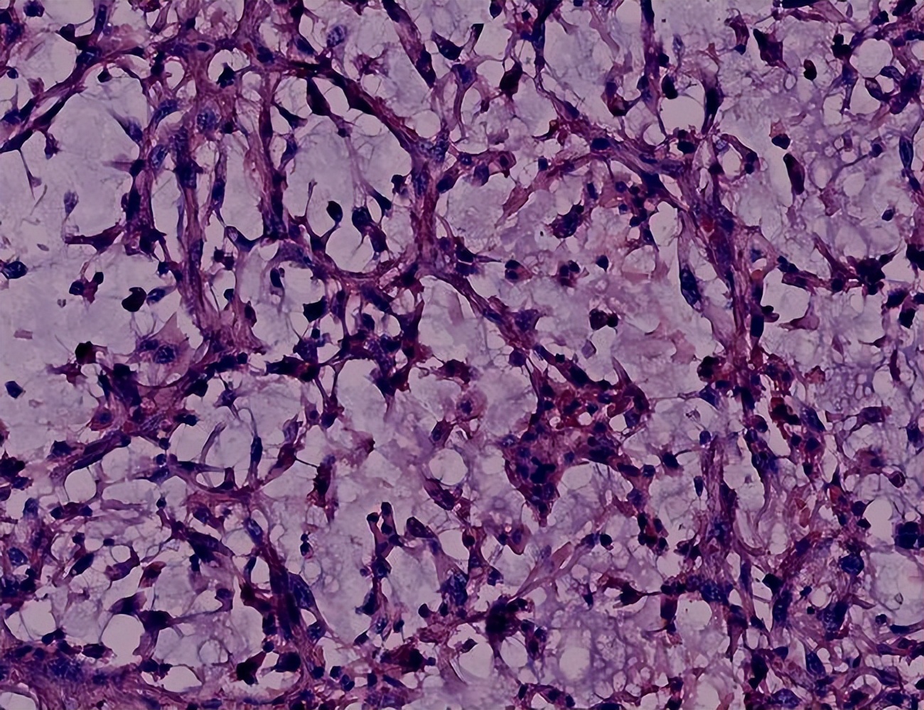 八十岁老人肝癌可以手术风险大吗,肝癌扩散怎么治疗治疗方案是什么