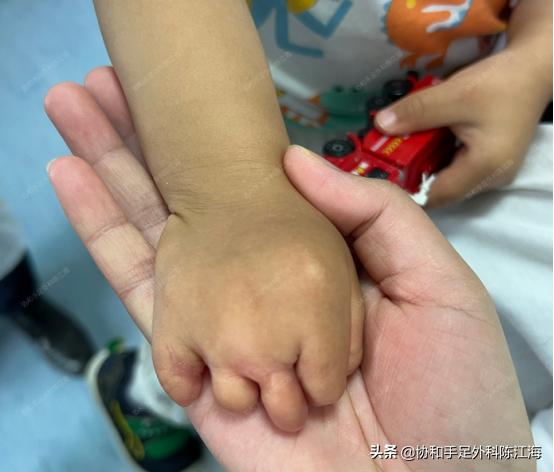 束带综合征手术多大可以做,束带综合征动手术后期有影响吗