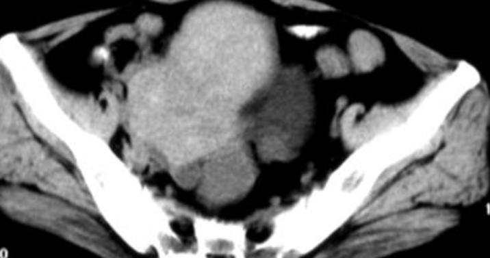 子宫内膜腺癌五年生存率,子宫内膜腺癌2期中分化患者自述